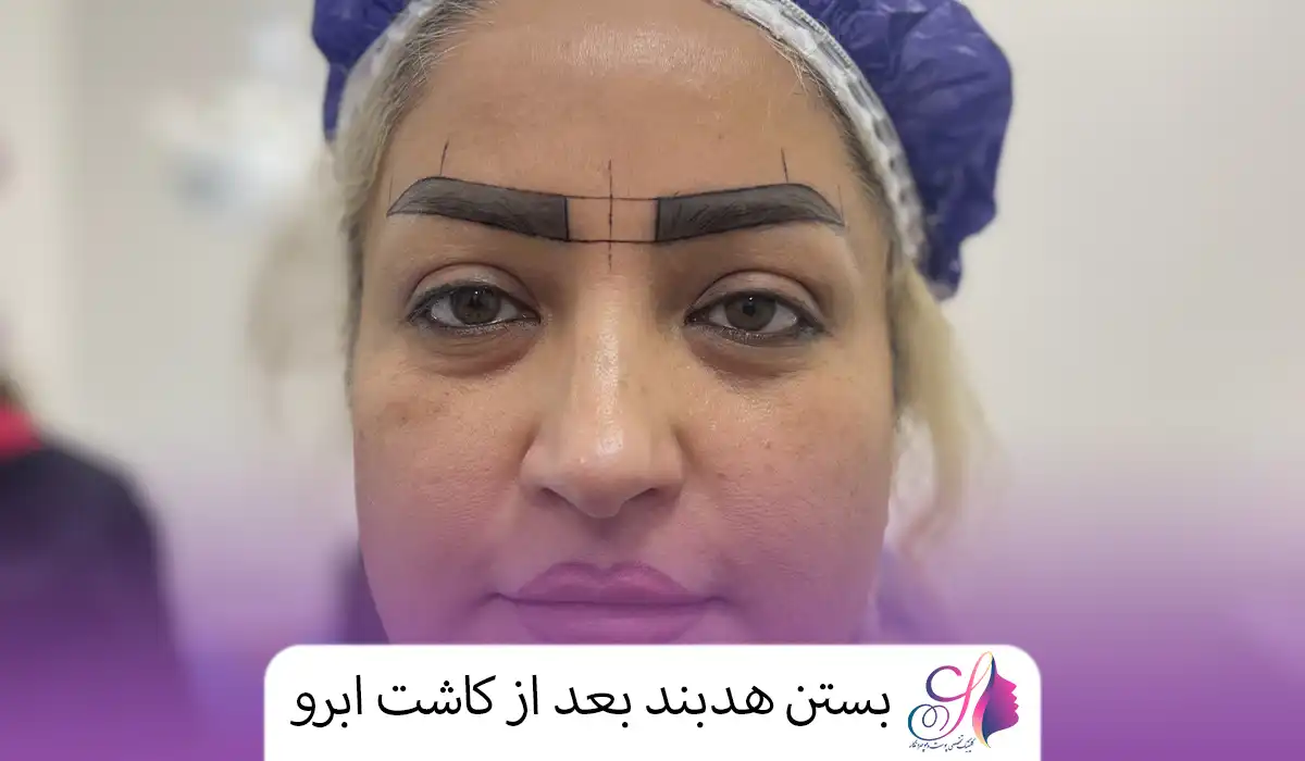بستن هدبند بعد از کاشت ابرو