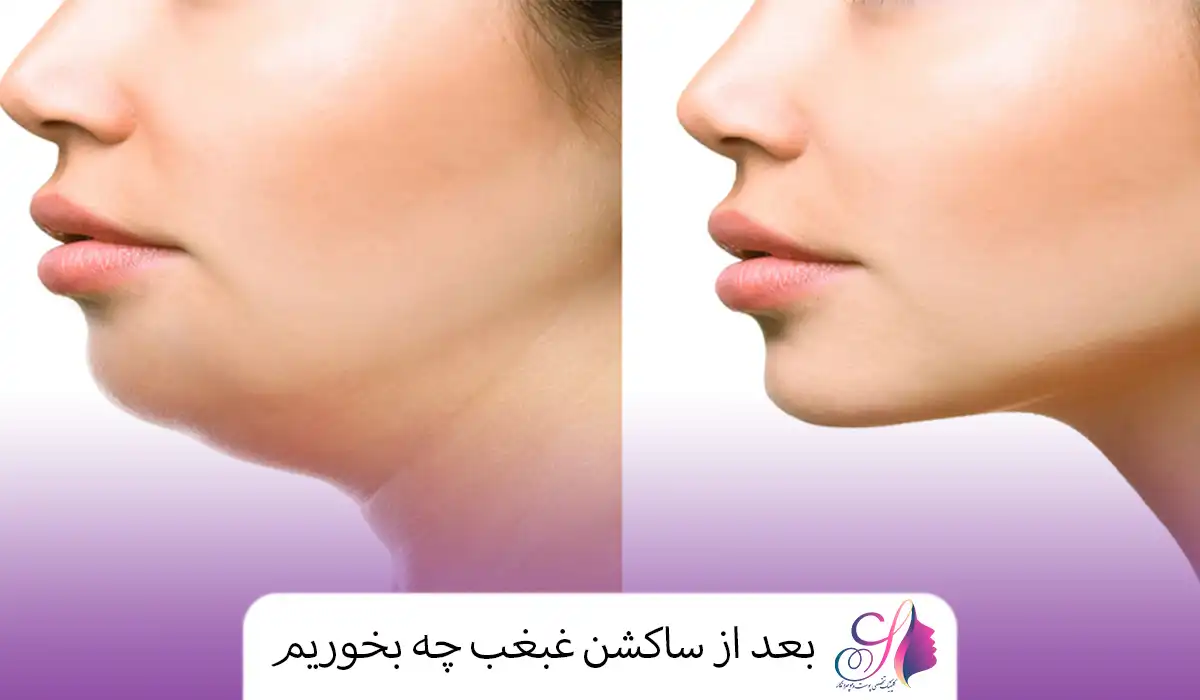 بعد از ساکشن غبغب چه بخوریم