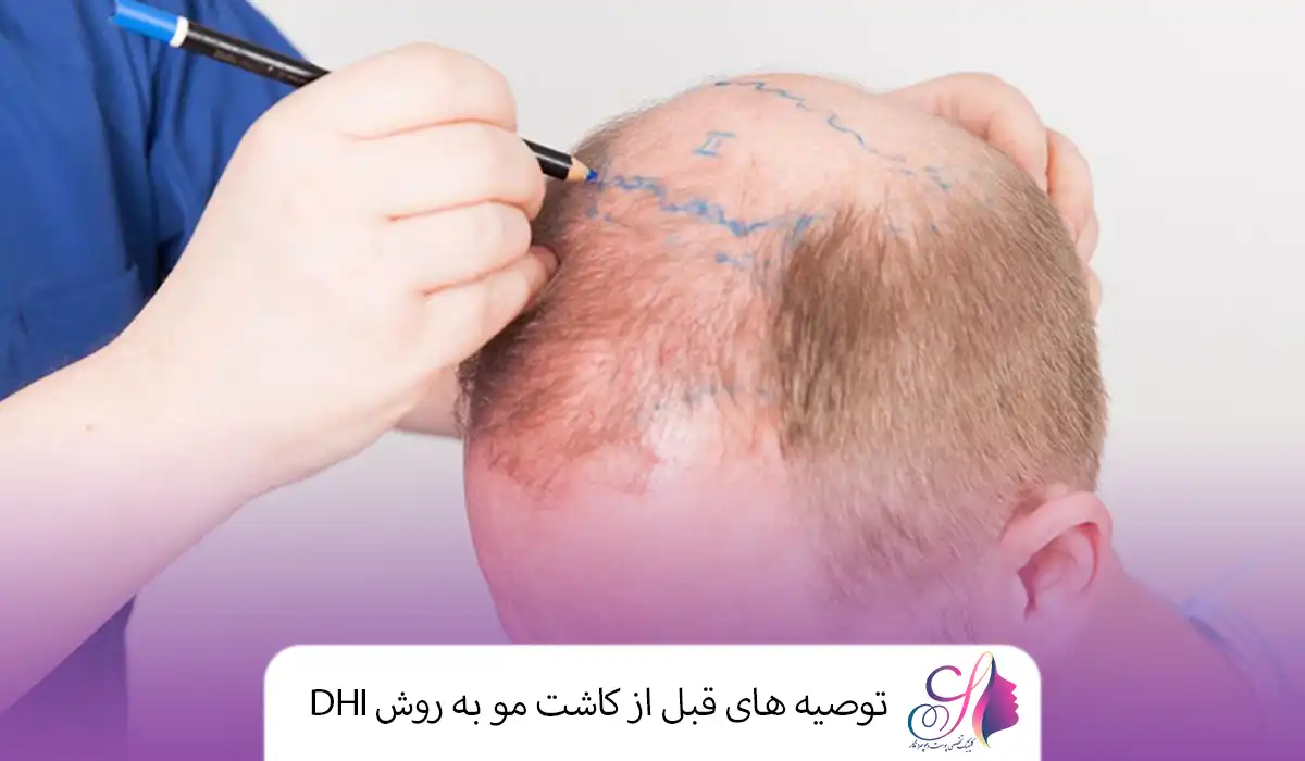 توصیه های قبل از کاشت مو به روش DHI