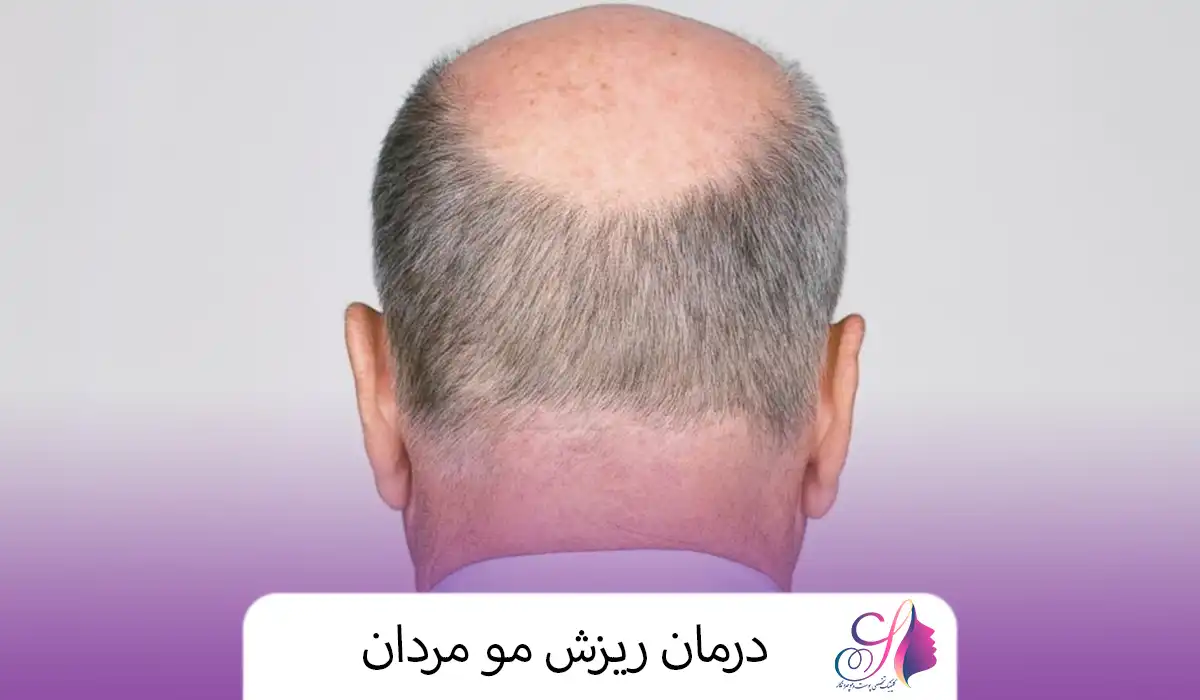 درمان ریزش مو مردان