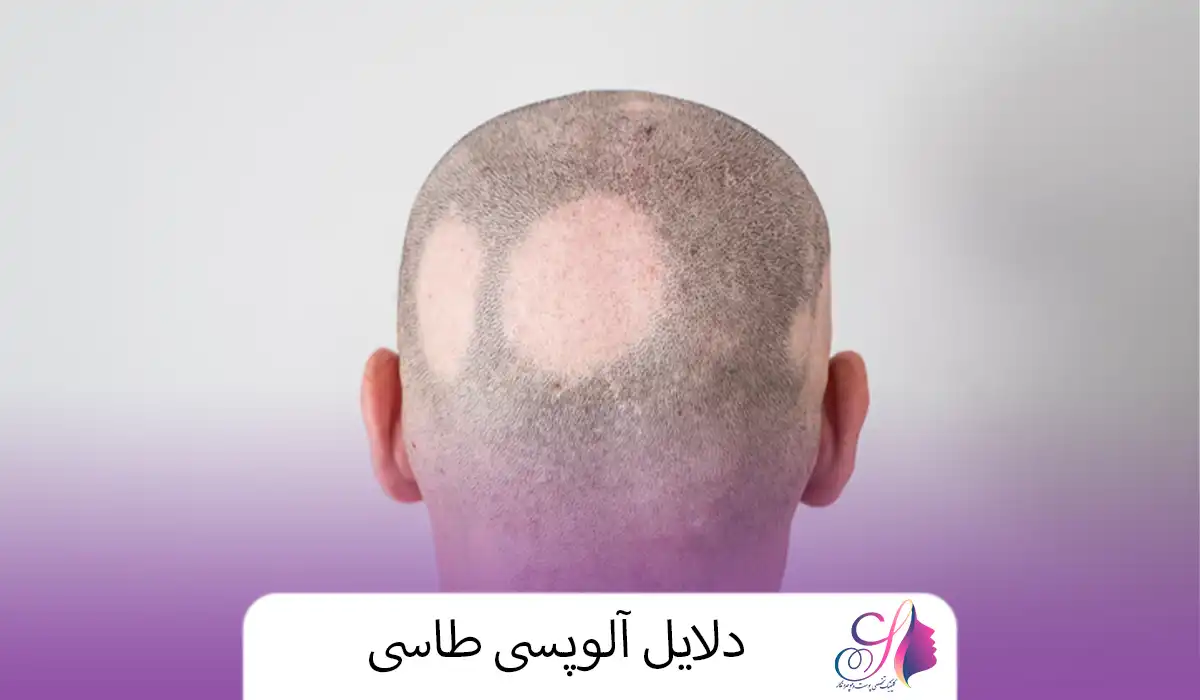 دلایل آلوپسی طاسی