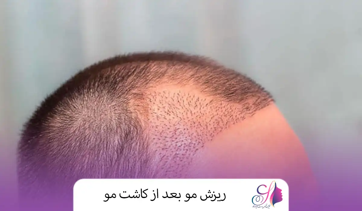 ریزش مو بعد از کاشت مو