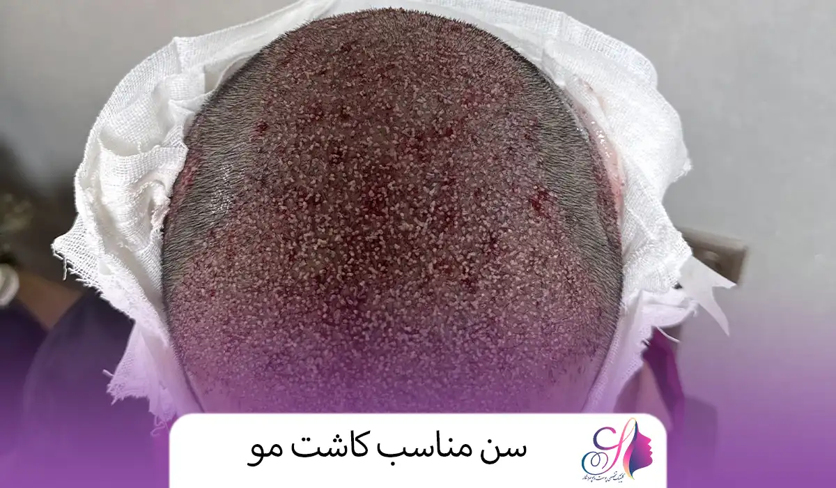 سن مناسب کاشت مو