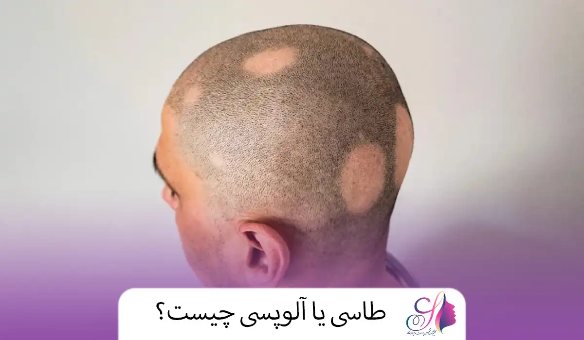 طاسی یا آلوپسی چیست؟