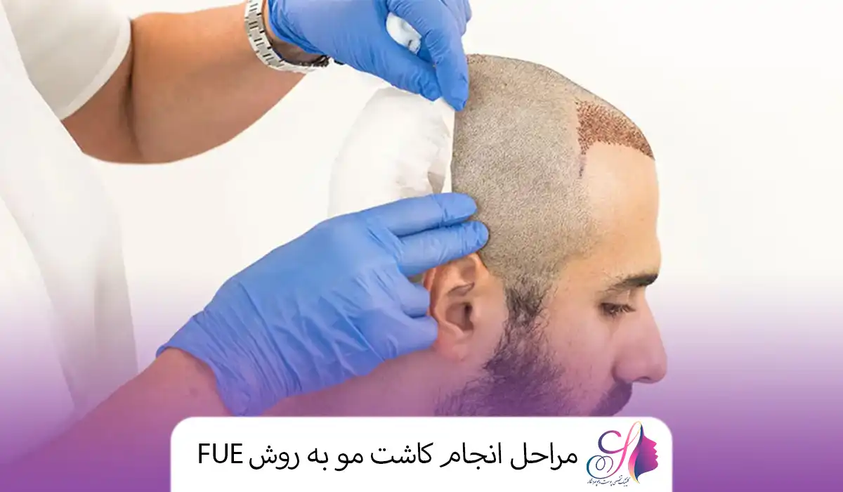 مراحل انجام کاشت مو به روش FUE