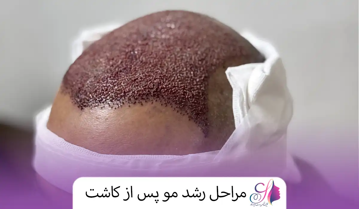 مراحل رشد مو پس از کاشت