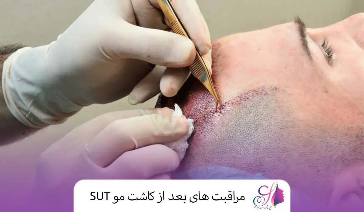 مراقبت های بعد از کاشت مو SUT