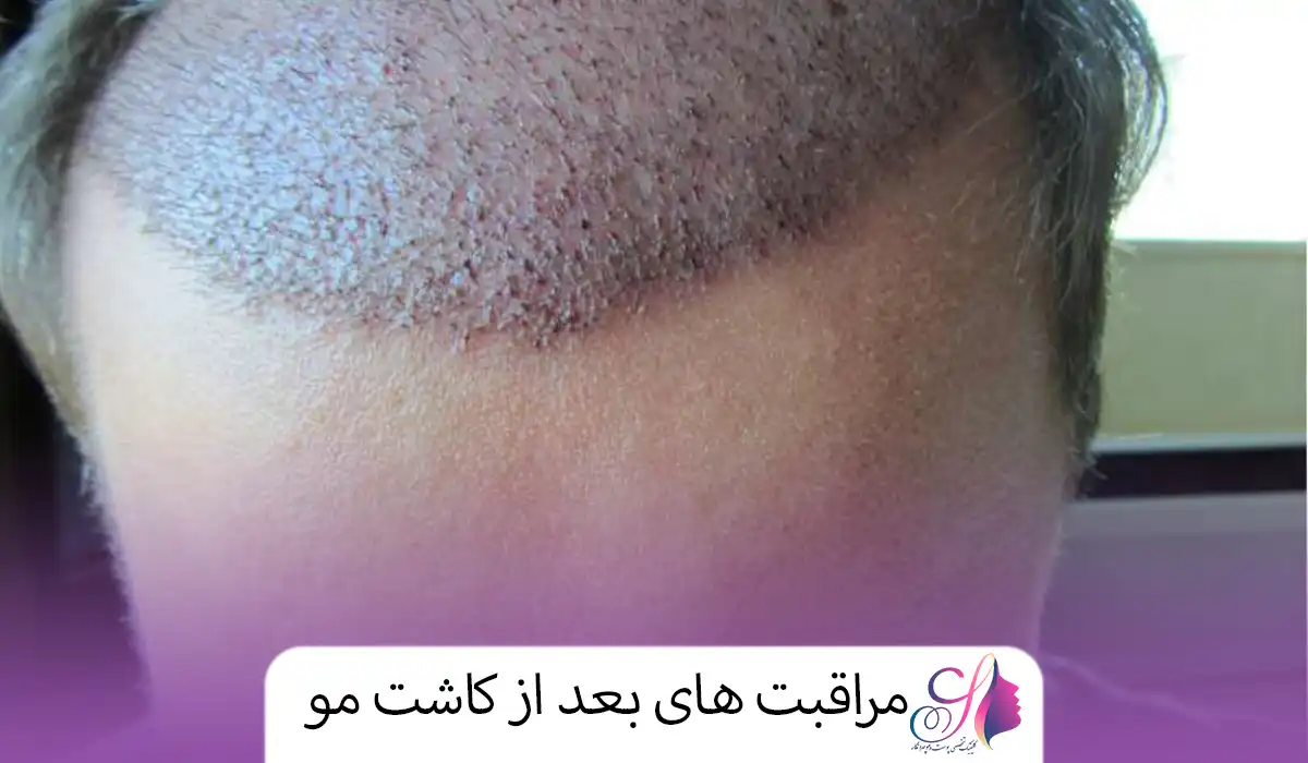 مراقبت های بعد از کاشت مو