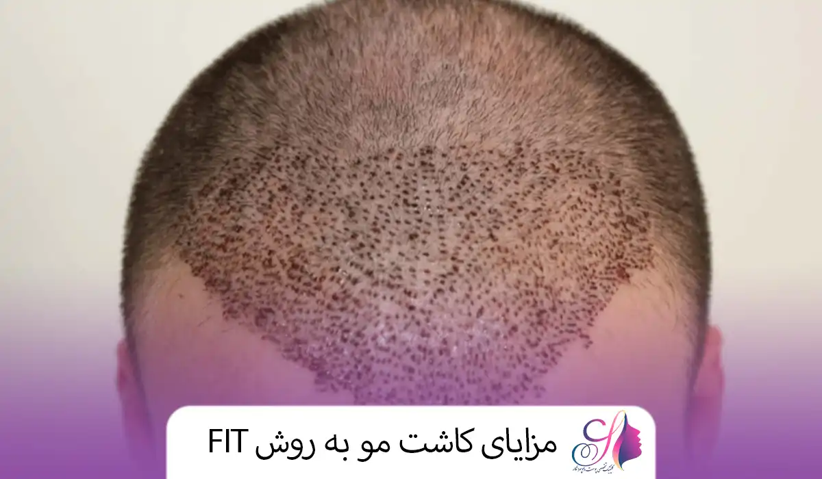 مزایای کاشت مو به روش FIT