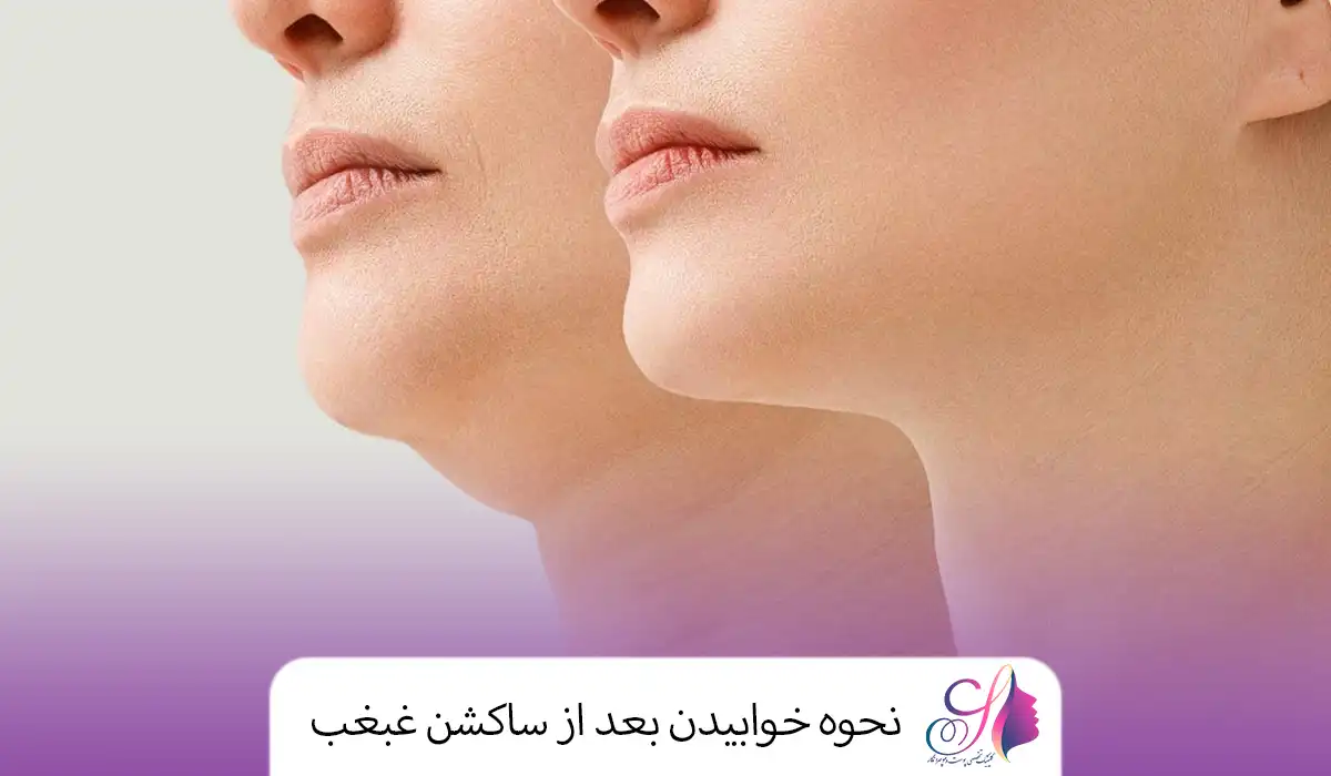 نحوه خوابیدن بعد از ساکشن غبغب
