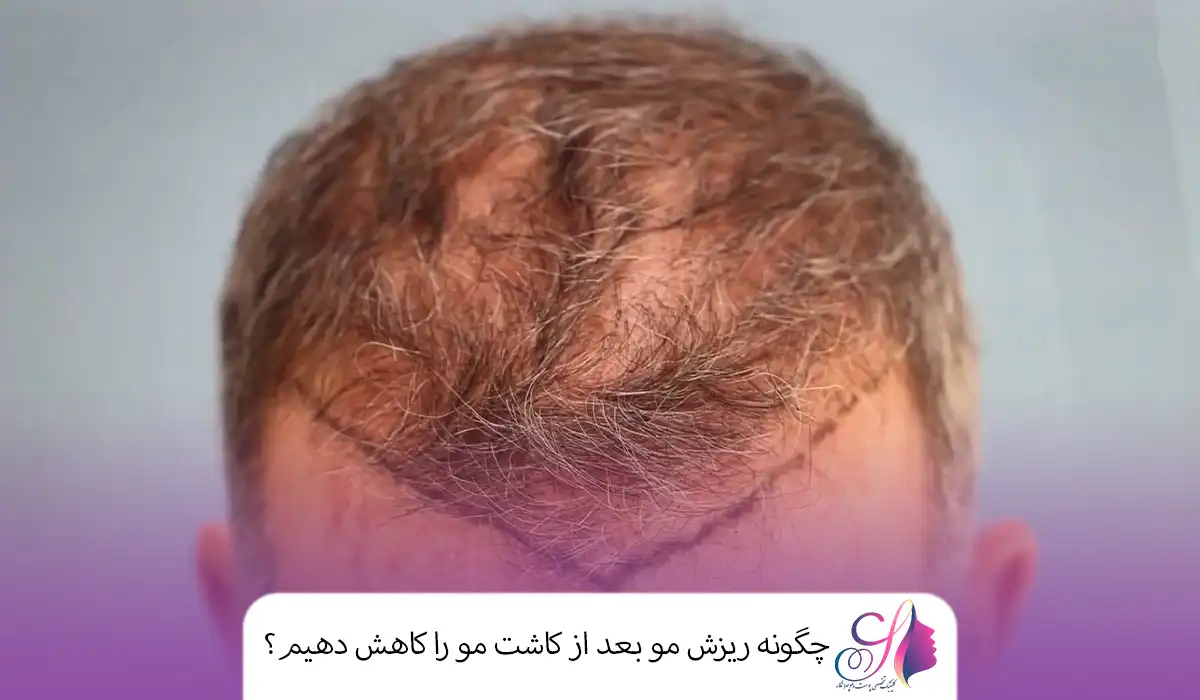 چگونه ریزش مو بعد از کاشت مو را کاهش دهیم؟