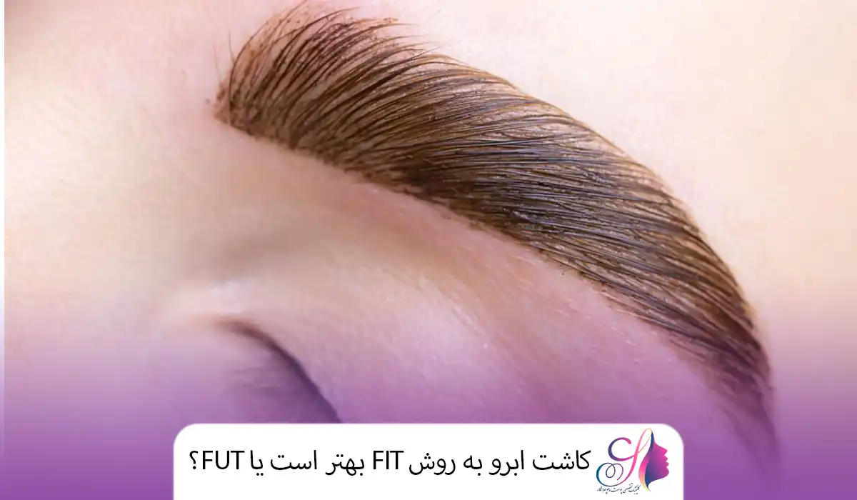 کاشت ابرو به روش FIT بهتر است یا FUT؟