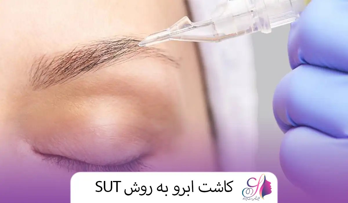 کاشت ابرو به روش sut