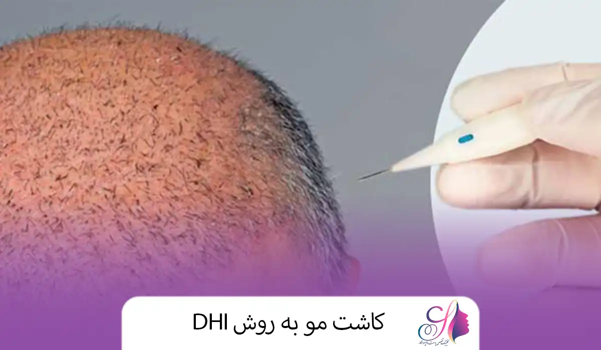 کاشت مو به روش DHI