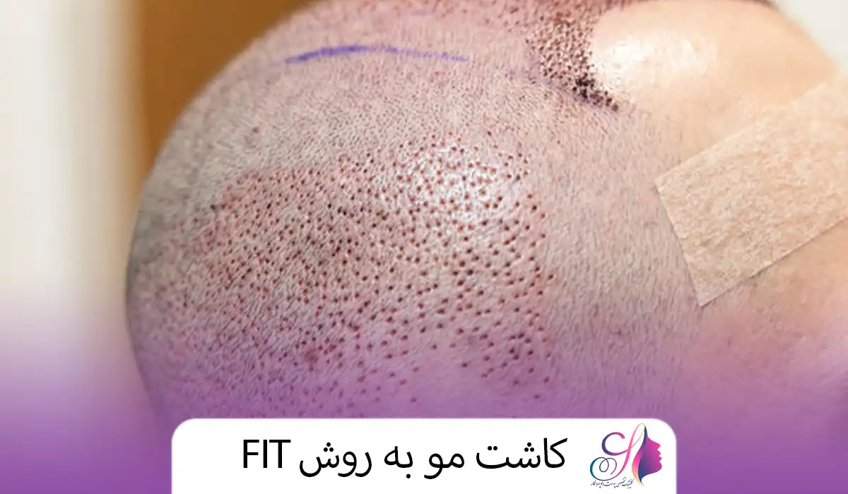 کاشت مو به روش FIT