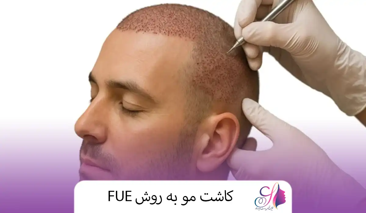 کاشت مو به روش FUE
