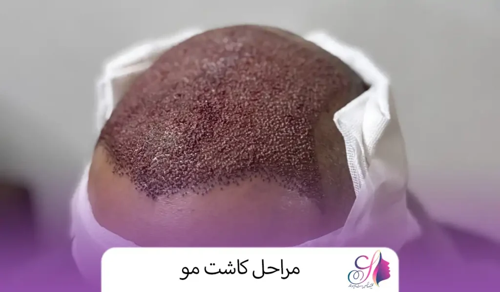 مراحل کاشت مو