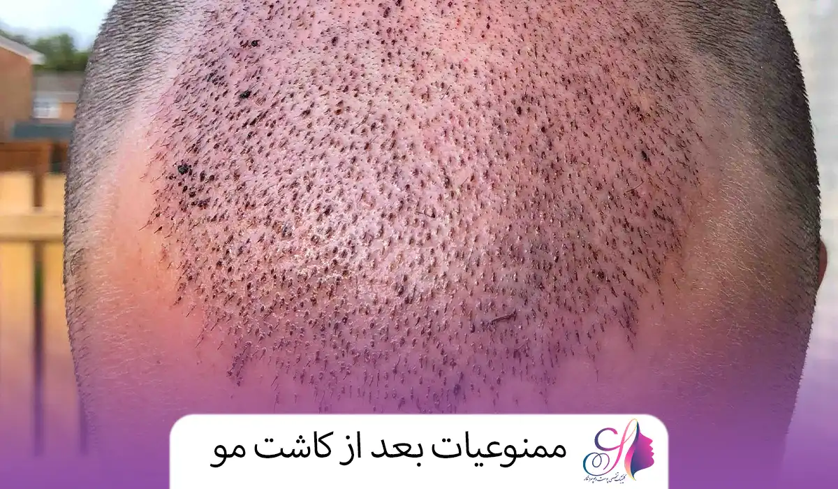 ممنوعیات بعد از کاشت مو