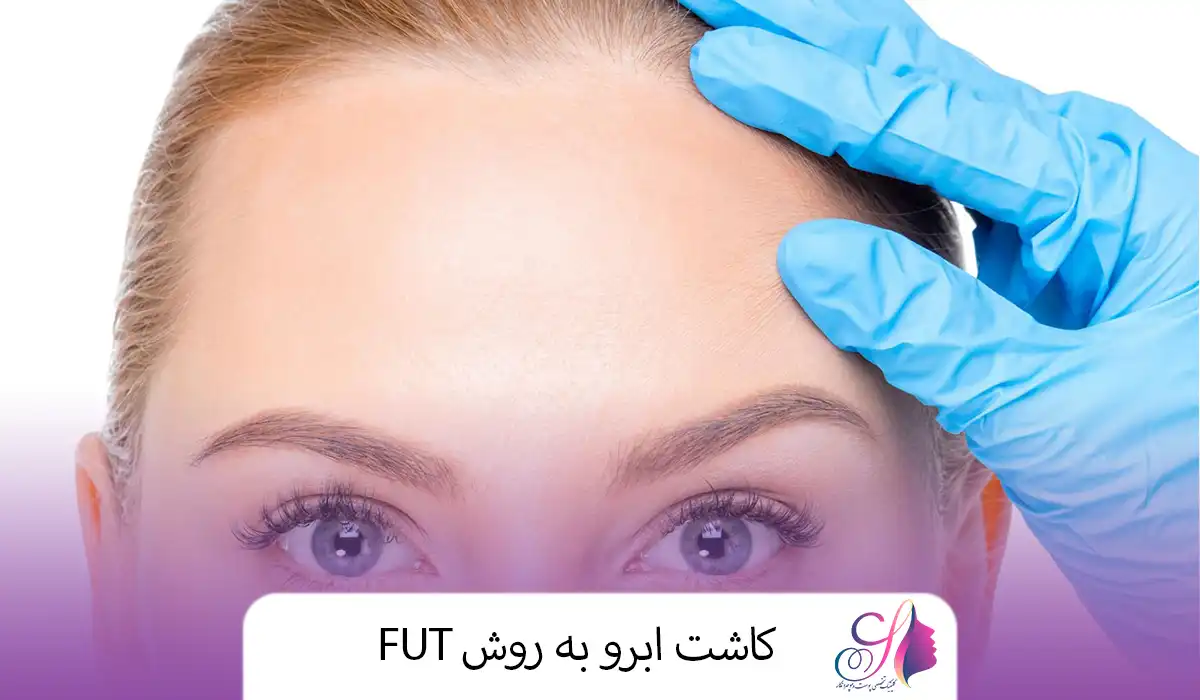 کاشت ابرو به روش FUT