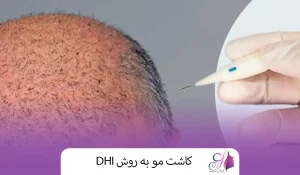 کاشت مو به روش DHI