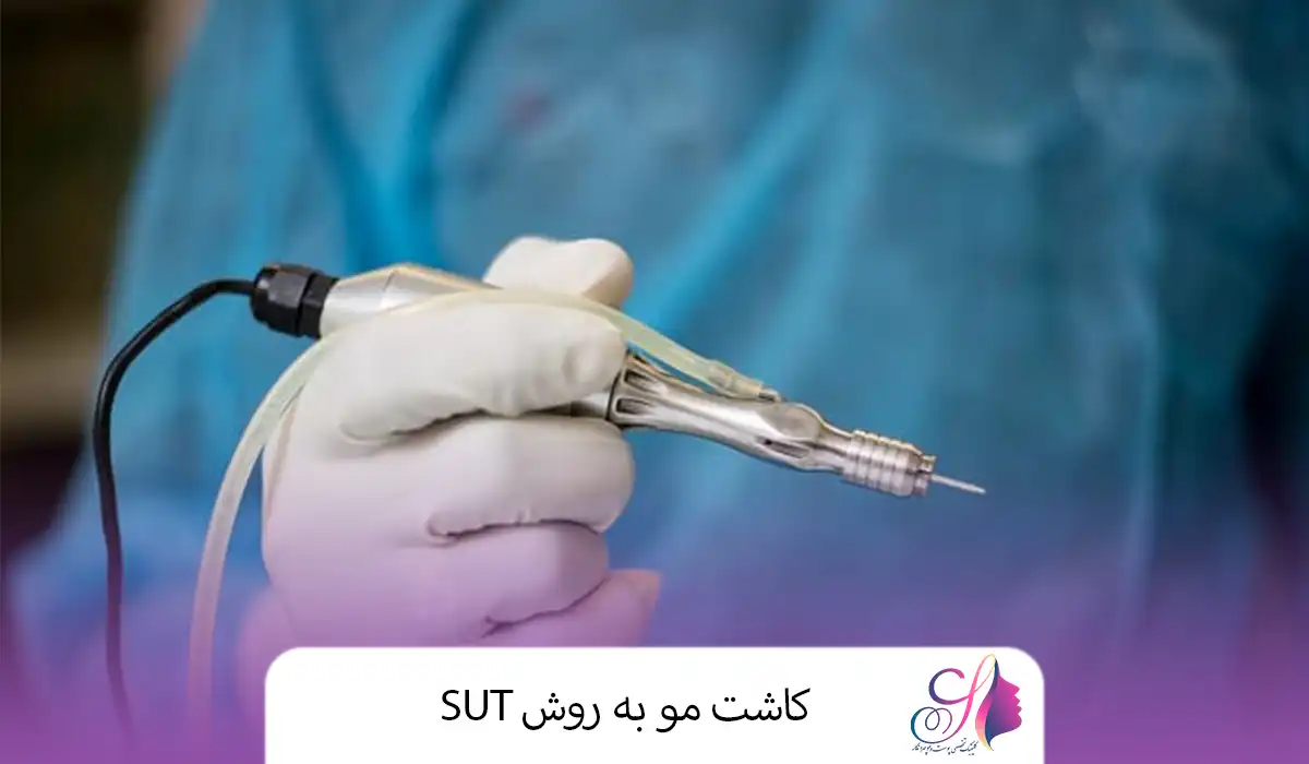 کاشت مو به روش SUT