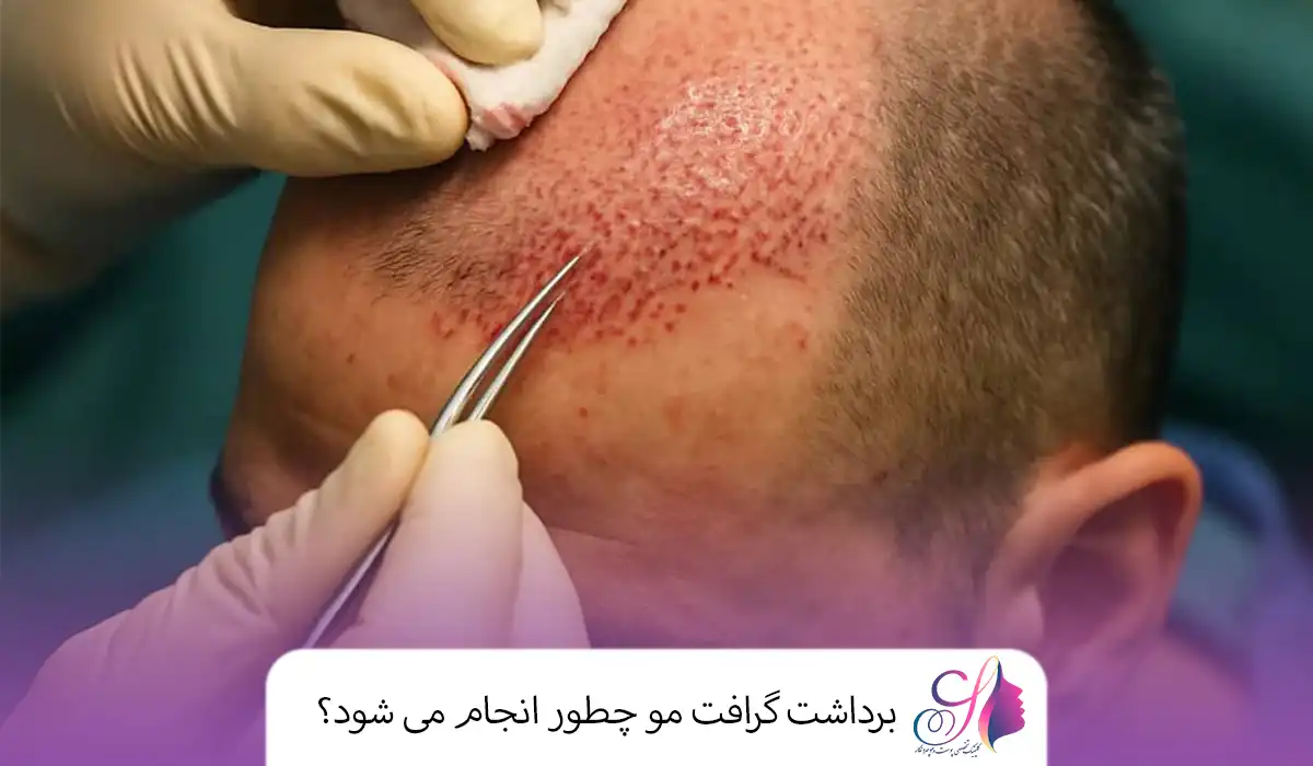 برداشت گرافت مو چطور انجام می ‌شود؟
