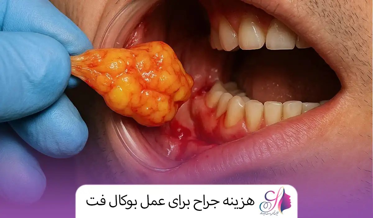 هزینه جراح برای عمل بوکال فت