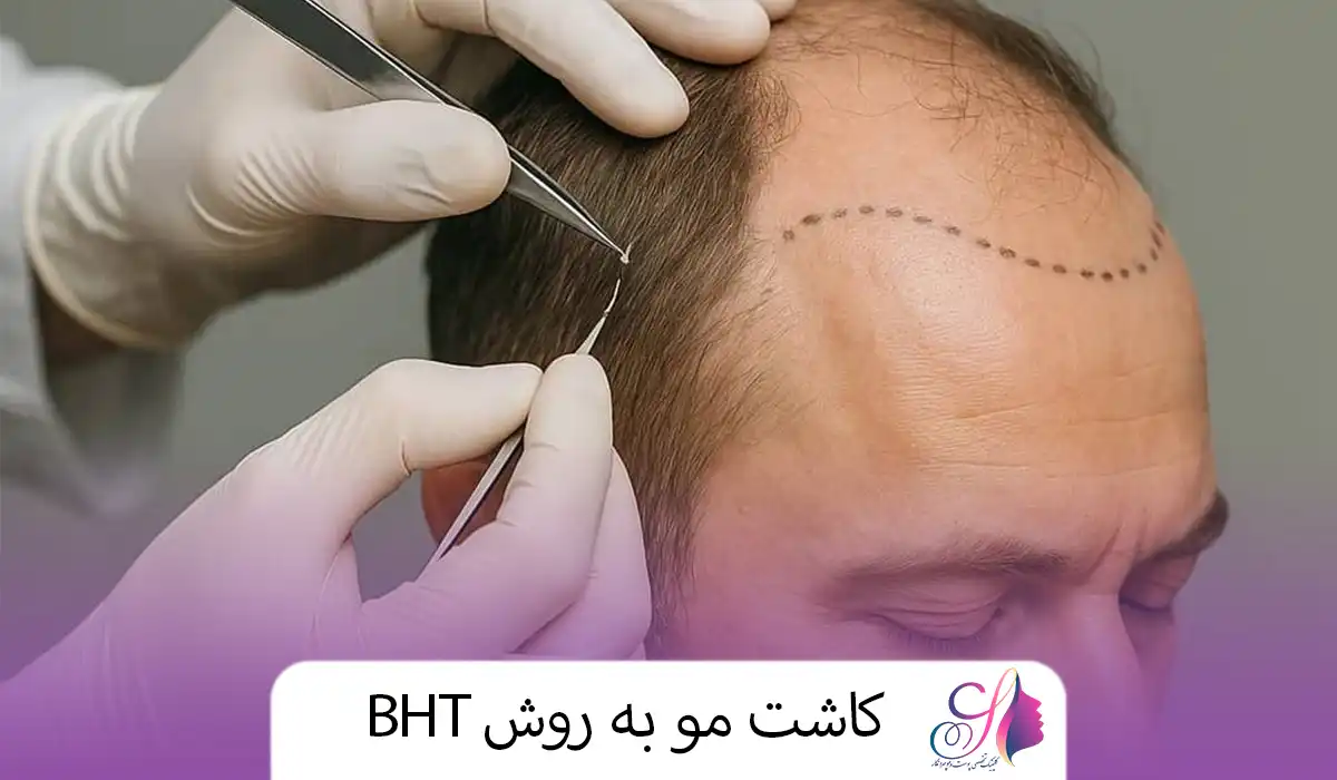کاشت مو به روش BHT