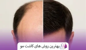 بهترین روش های کاشت مو
