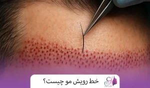 خط رویش مو چیست؟