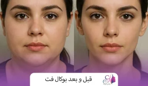 قبل و بعد بوکال فت