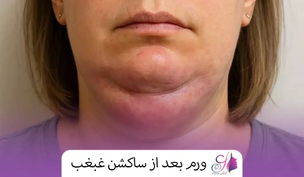ورم بعد از ساکشن غبغب