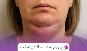 ورم بعد از ساکشن غبغب