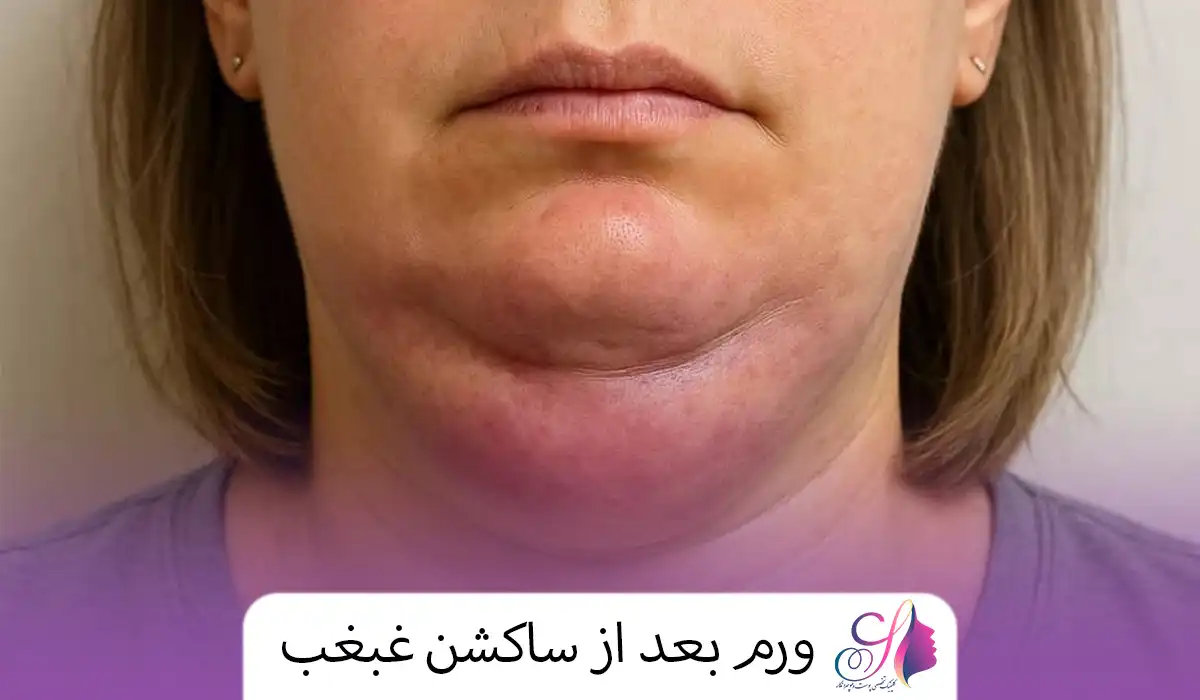 ورم بعد از ساکشن غبغب