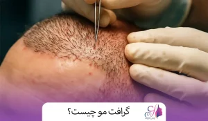 گرافت مو چیست؟