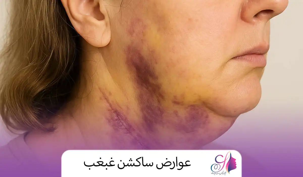 عوارض ساکشن غبغب