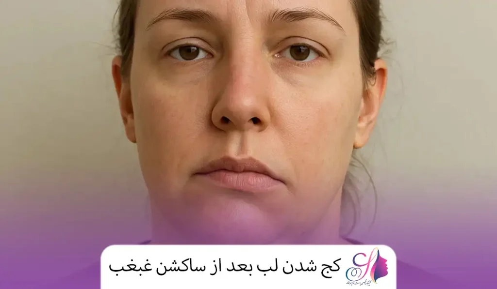کج شدن لب بعد از ساکشن غبغب