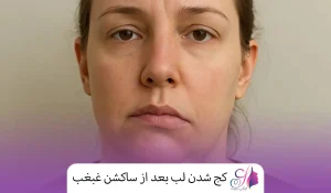 کج شدن لب بعد از ساکشن غبغب